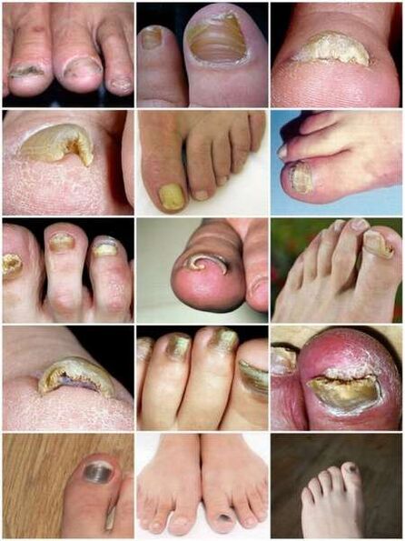 Infecția fungică a plăcii unghiilor de la picioare