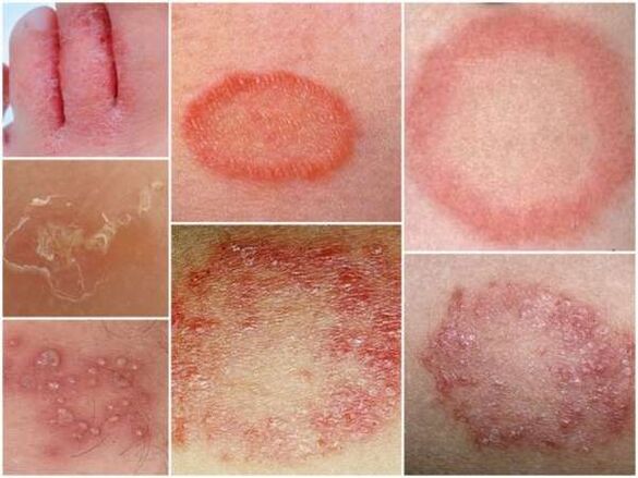 Trichofitoza pielii picioarelor