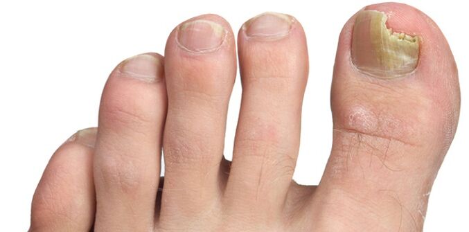 infecție fungică a plăcii unghiei